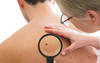New drug to fight skin cancer developed