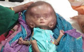 ધરમપુરની માતા એલિયન જેવા બાળક