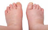 water retention in legs