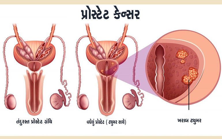 પુરુષોએ પ્રોસ્ટેટ કેન્સરના વ પુરુષોએ પ્રોસ્ટેટ કેન્સરના વ