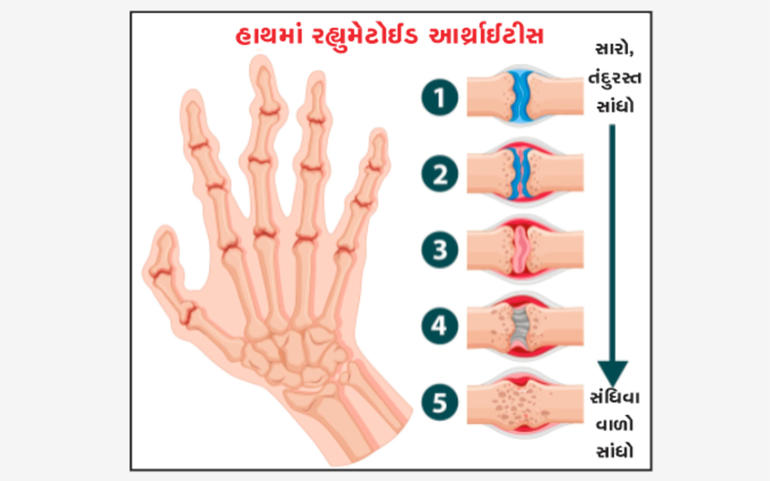 ઘૂંટણ અને થાપાનો દુઃખાવો ગંભી ઘૂંટણ અને થાપાનો દુઃખાવો ગંભી