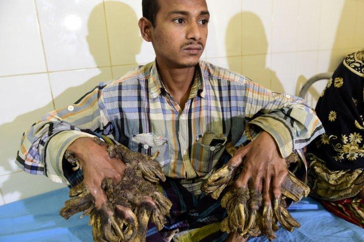Bangladesh Tree Man