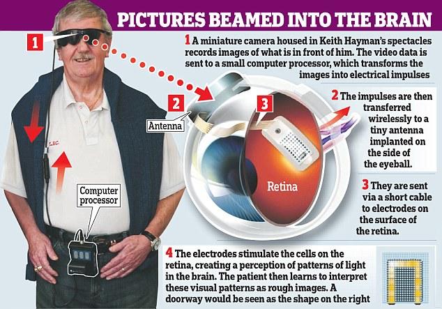 Bionic eye