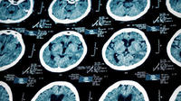 Drug to halt Alzheimer's copy Drug to halt Alzheimer's copy