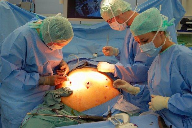 Gastric band surgery