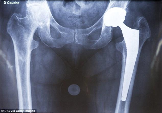 Hip-Knee Replacements-1
