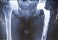 Hip-Knee Replacements-1 Hip-Knee Replacements-1