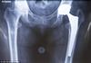 Hip-Knee Replacements-1