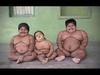 Obese Children UNA